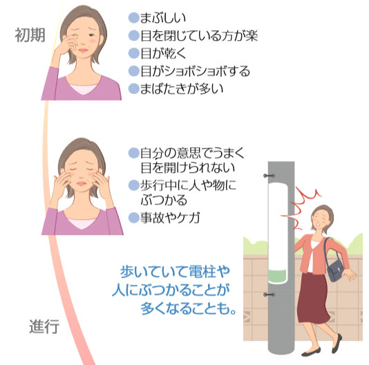 眼瞼痙攣の主な症状